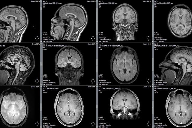 Les tribunaux ont déjà fait appel aux images de l’anatomie du cerveau pour évaluer la responsabilité pénale d’un prévenu. (Photo: AdobeStock / Delphotostock)