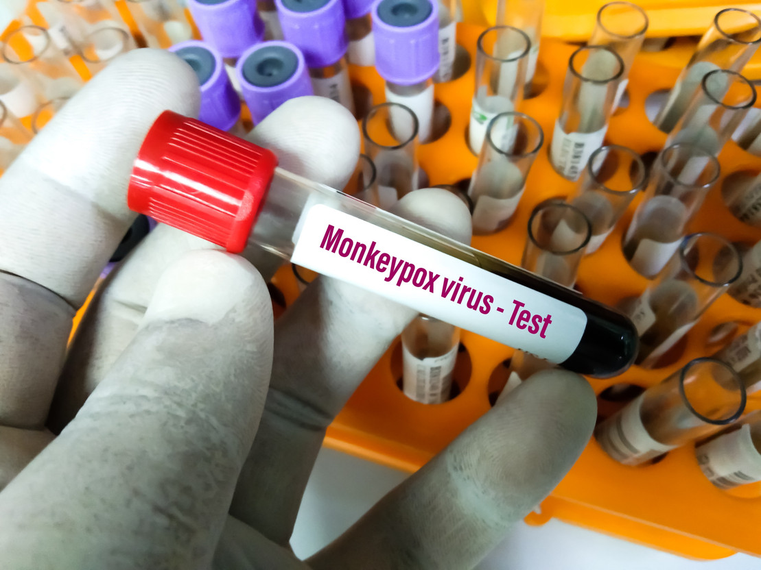 WHO is currently holding an open consultation for a new name to replace monkeypox and has invited anyone wishing to propose ideas to do so on a dedicated webpage. Arif biswas/Shutterstock.