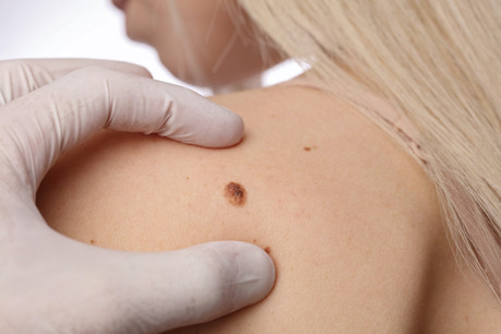 Le suivi des taches ou grains de beauté pourrait devenir «plus facile» avec le développement de technologies de reconnaissance. Dans certaines conditions. (Photo: Shutterstock)