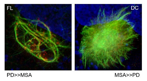 Images microscopiques en haute résolution de cultures cellulaires où l’alpha-synucléine (en vert) présente une structure filamenteuse (à gauche), plus susceptible de mener à la maladie de Parkinson, ou une structure à noyau dense (à droite), plus susceptible de mener à une atrophie multi-systématisée.  (Visuel: Ayami Okuzumi)